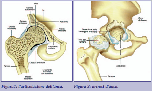 articolazione di anca sana e artrosica
