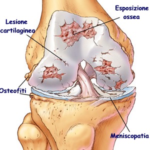 artrosi ginocchio