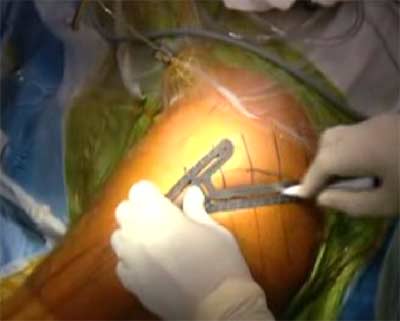 intervento di protesi allanca