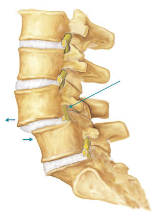 spondilolisi