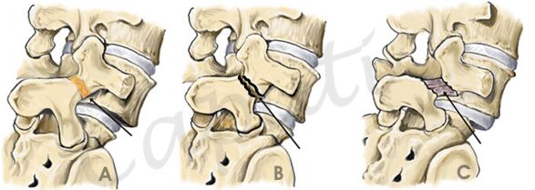 spondilolisi e spondilolistesi